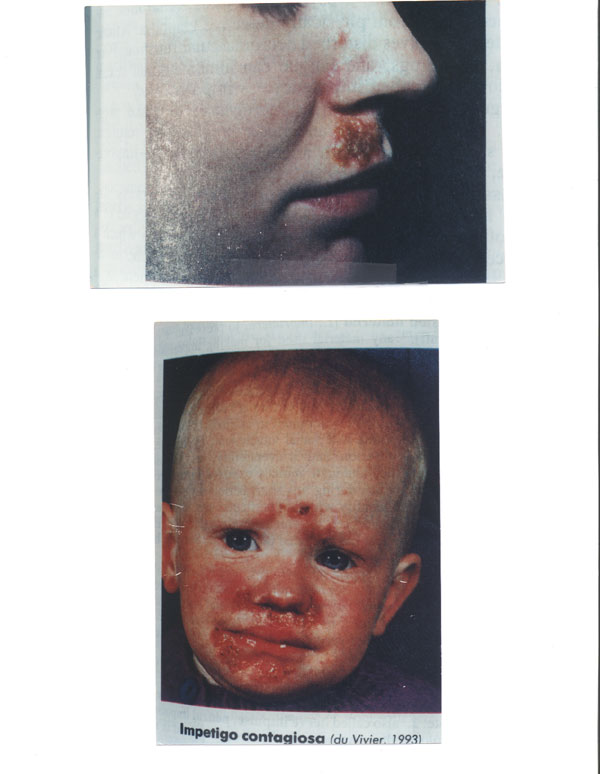 impetigo2.jpg