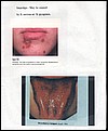 impetigo1.jpg