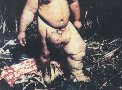 filariasis.jpg