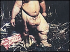 filariasis.jpg